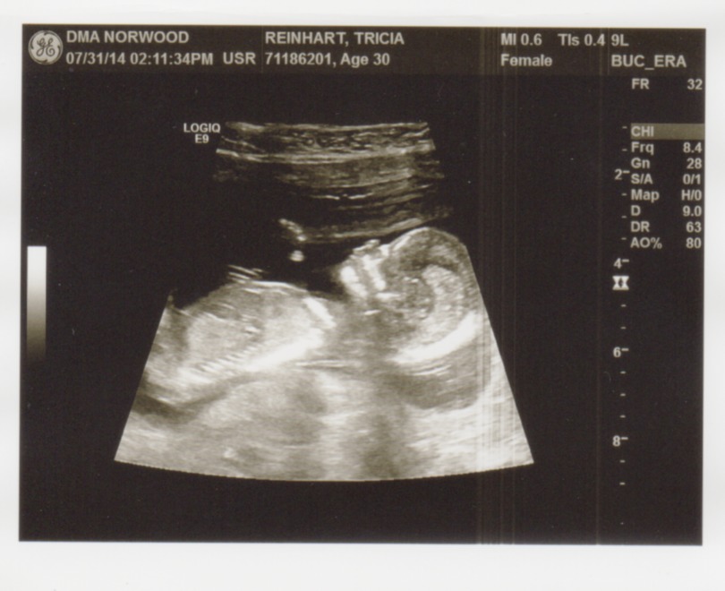 Baby-Ultrasound-13wks-FB-Tricia